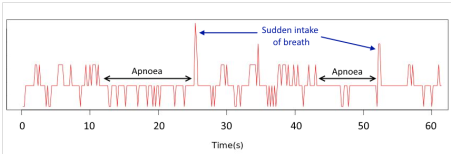 Sleep Apnoea Detector Sleep Apnoea Detector